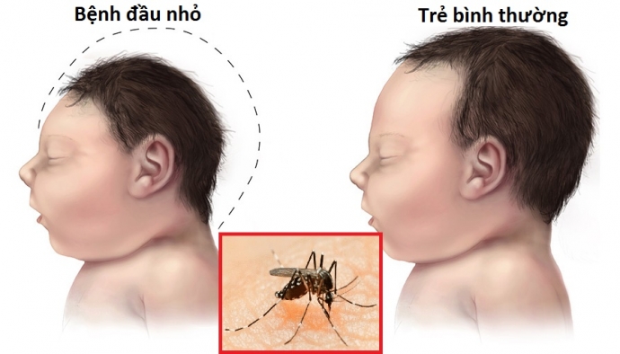 Zika gây dị tật đầu nhỏ