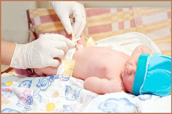 Rốn trẻ sơ sinh rất dễ nhiễm trùng dẫn tới nhiễm t