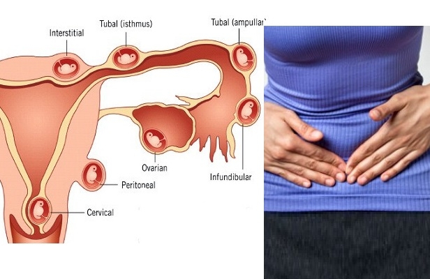 Chửa ngoài dạ con rất nguy hiểm