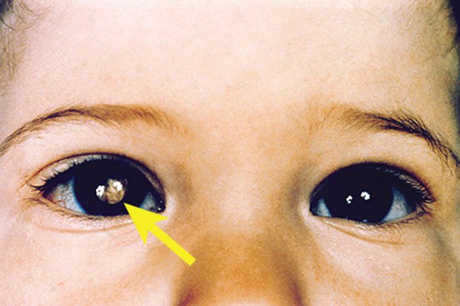 guide-to-eye-cancers-s4-retinoblastoma