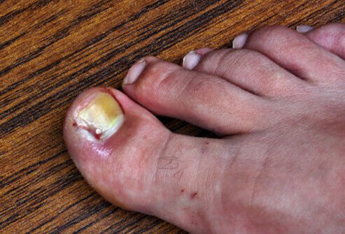 ingrown-toenails-s3-look-like