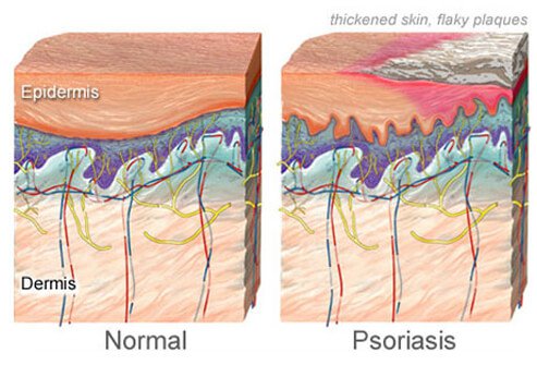 psoriasis-causes-symptoms-treatments-s5-illustration-of-psoriasis