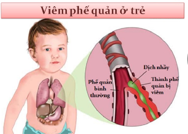 Viêm phế quản ở trẻ nhỏ là tình trạng viêm nhiễm kích thích ở niêm mạc phế quản.