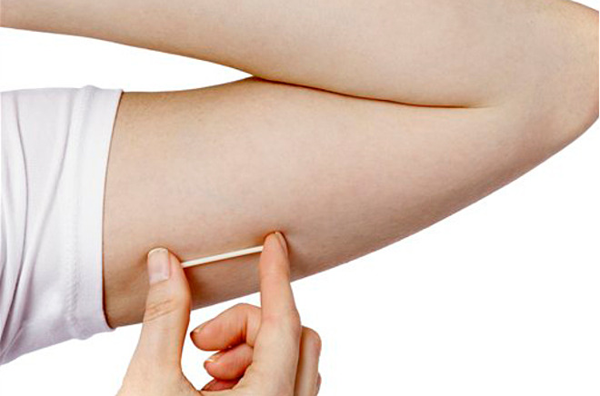 Que tránh thai được cấy vào dưới mặt trong cánh tay.