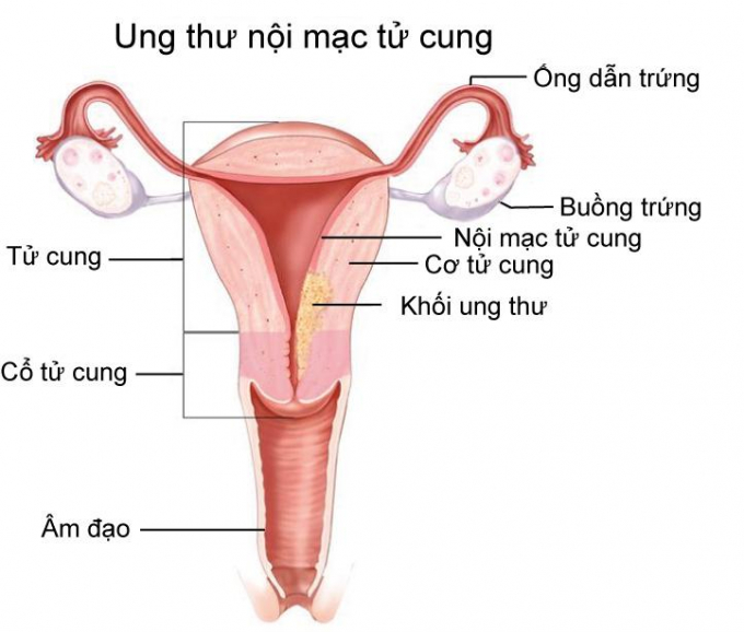 ung-thu-noi-mac-tu-cung