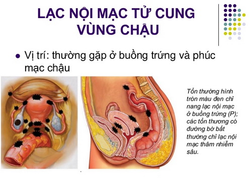 lsieu-am-co-phat-hien-lac-noi-mac-tu-cung1_resize