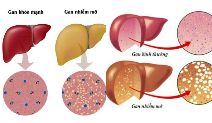 gan-nhiem-mo