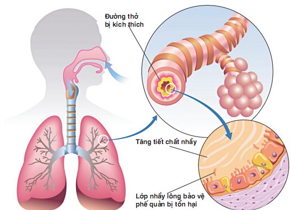 troi-lanh-rat-de-viem-phoi-8-dau-hieu-to-cao-benh-som-biet-de-ngua-bien-chung-nguy-hiem