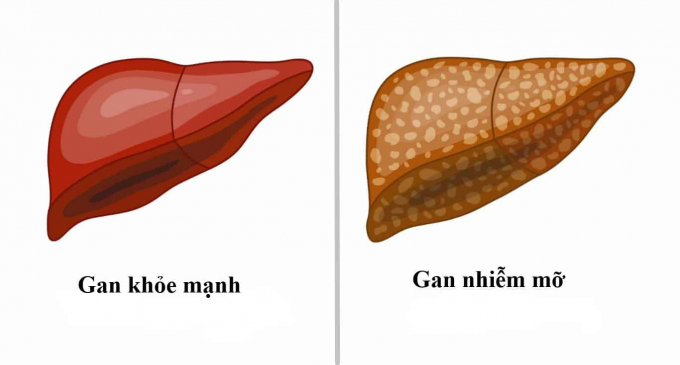 phong-benh-gan-nhiem-mo-bat-dau-tu-che-do-an1