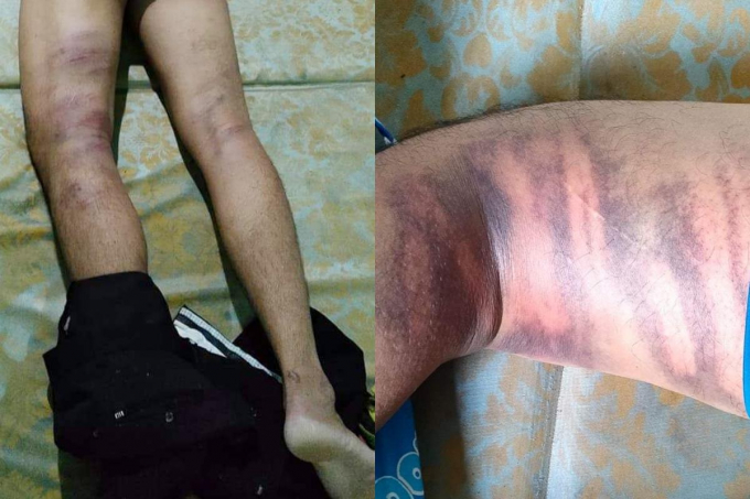 Ông Bình bị đánh gây nhiều thương tích.