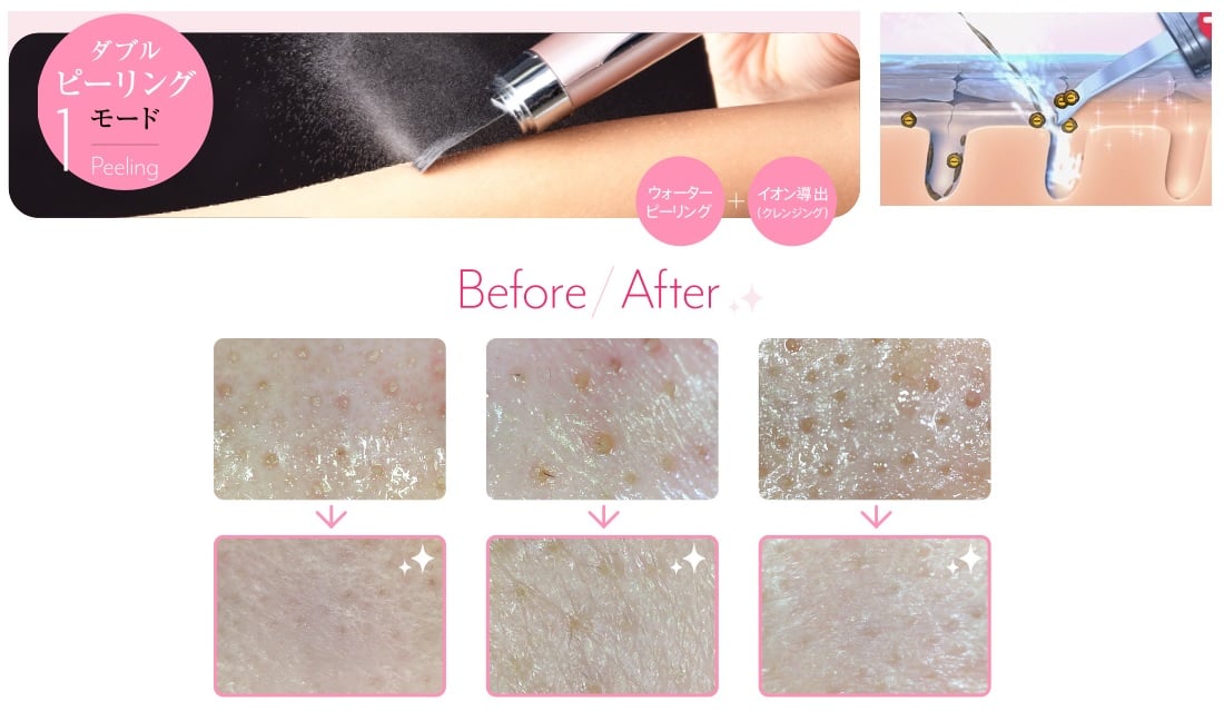 Chế độ Double Peeling – Làm sạch da: Khi hoạt động ở chế độ làm sạch đầu máy rung liên tục , đồng thời các I0n trái dấu được tạo da để dễ dàng loại bỏ các mụn cám, mụn đầu đen. da chết, các chất bẩn trong lỗ chân lông, trả lại làn da sạch sẽ và sáng bóng.