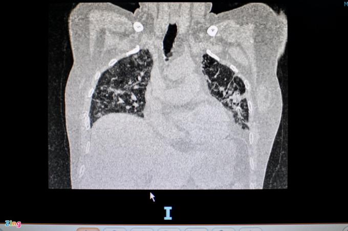 Phim X-quang của bệnh nhân N.T.T. (56 tuổi) mắc di chứng hậu Covid-19, được chẩn đoán xơ phổi và suy hô hấp mức độ nặng. Trên phim, phổi của bệnh nhân mờ đục, vị trí tổn thương nhiều. Sau khi khỏi Covid-19, bệnh nhân này vẫn phải nằm thở oxy hơn một tháng tại nhà.