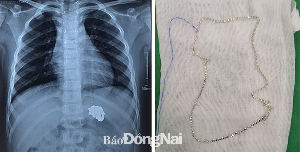 Hình ảnh chụp X-quang và sợi dây chuyền sau khi được lấy ra