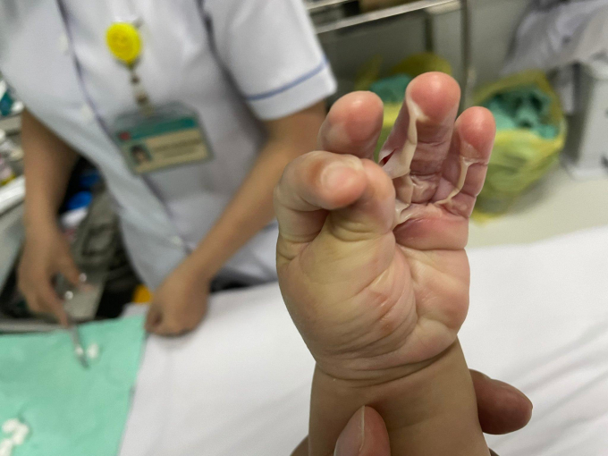 Vết bỏng trên tay con bà Hậu.