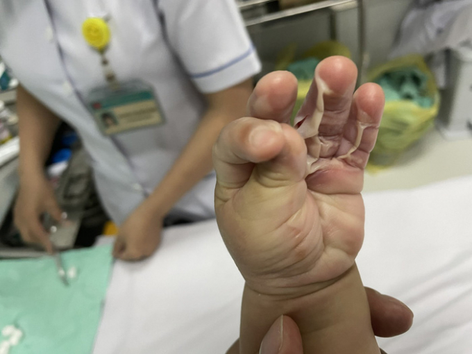 Bàn tay của con trai bị bỏng do nước nóng - Ảnh: NVCC