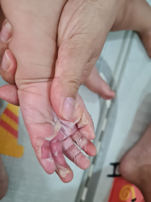Chị H. cho rằng bác sĩ của Bệnh viện FV kê sai đơn thuốc khiến vết bỏng của con trai chị trở nặng - Ảnh: Chị H. cung cấp
