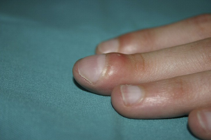 Tình trạng điển hình của người có ngón tay dùi trống. Ảnh: Journal of the American Academy of Dermatology.