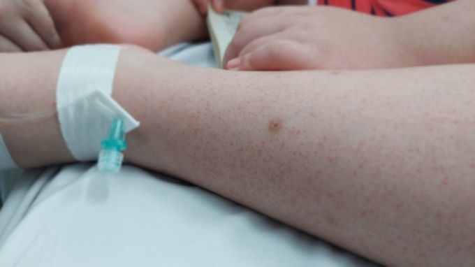 Trẻ sốt xuất huyết xuất hiện ban đỏ trên da