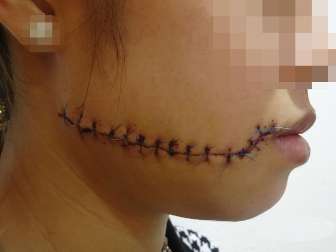 Bệnh nhân nhập viện với vết sẹo to và tâm lý lo lắng BÁC SĨ CUNG CẤP