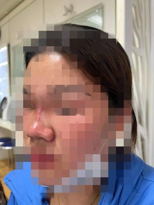Bệnh nhân bị tai biến sau khi tiêm filler vào mũi. Ảnh: BSCC