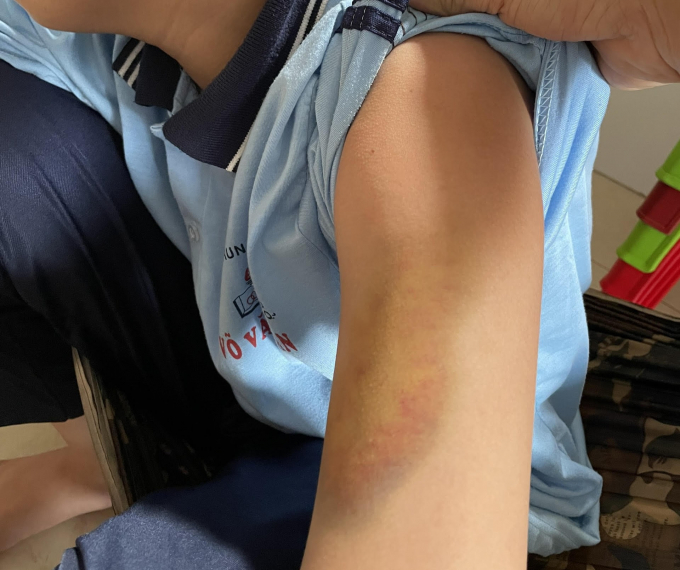 Em N.H.N, học sinh lớp 6A4 Trường THCS Võ Văn Tần, bị bạn đánh hội đồng 3 lần trong khu nhà vệ sinh của trường KHÔI NGUYÊN