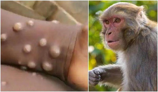 Bệnh đậu mùa khỉ đang gia tăng cấp độ lây nhiễm trên toàn cầu, đe dọa sức khỏe cộng đồng