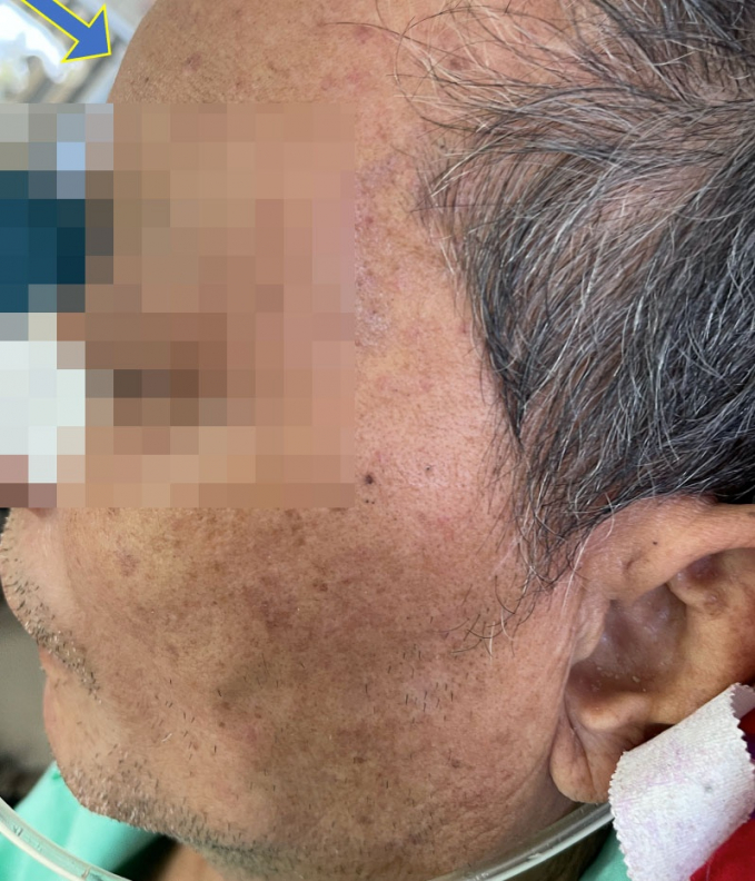 Một bệnh nhân bị hoại tử xương sọ mặt điều trị tại Bệnh viện Chợ Rẫy BVCC