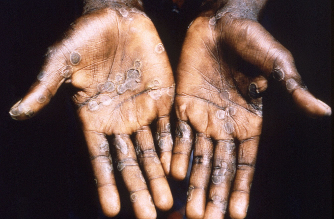 Bàn tay của một người mắc đậu mùa khỉ REUTERS