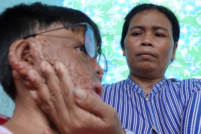 Sau 2 năm tai nạn kinh hoàng, Chính đã trải qua hơn 20 cuộc phẫu thuật ghép da DUY TÂN