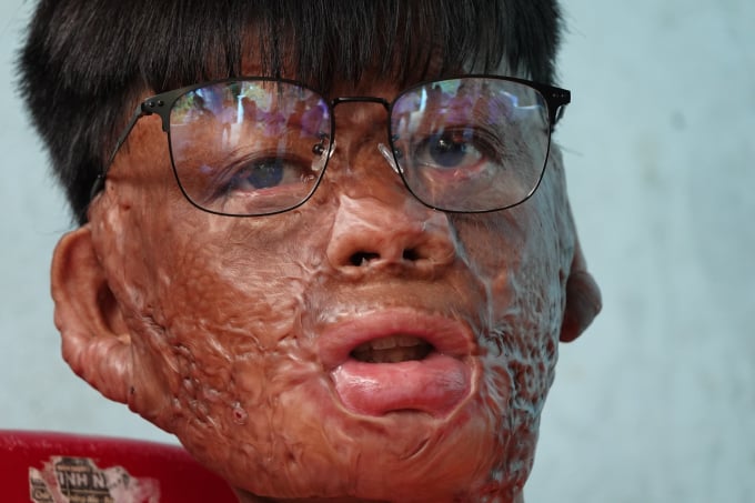 Gương mặt của Chính biến dạng hoàn toàn do bỏng nặng DUY TÂN