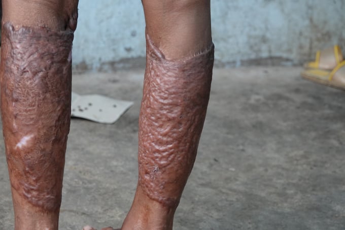 Phần chân với những vết bỏng chằng chịt DUY TÂN