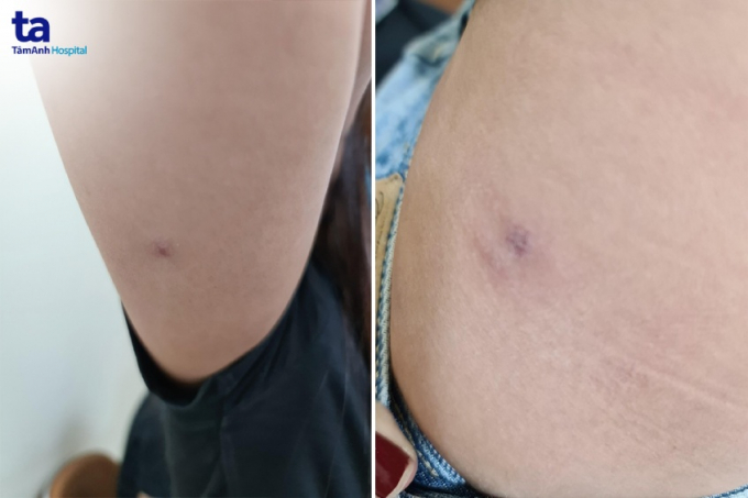 Những cục u xơ xuất hiện dưới cánh tay và vùng bụng của chị T.