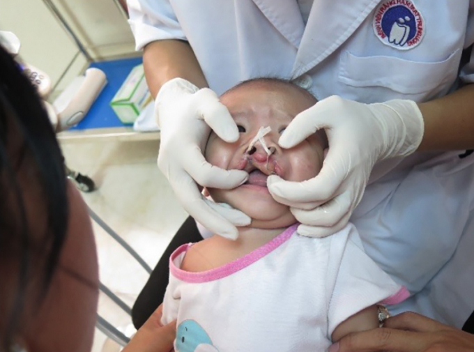 Bệnh nhi được bác sĩ thăm khám để lên phương pháp điều trị - Ảnh: Bệnh viện Răng hàm mặt Trung ương TPHCM