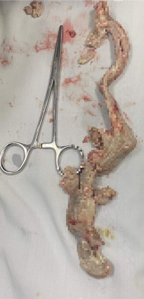 Đoạn lòng lợn dài 25 cm gắp ra từ cổ của bệnh nhân