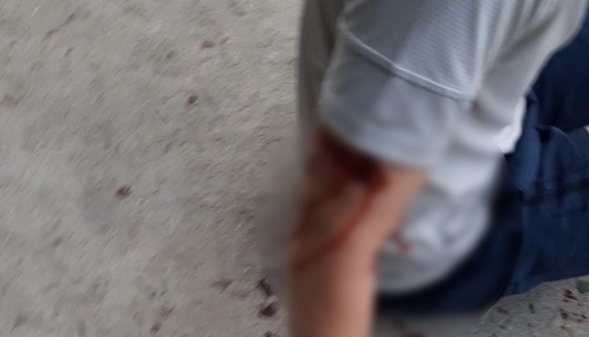 Du khách nước ngoài bị chó cắn bị thương ở cánh tay. Ảnh CTV.