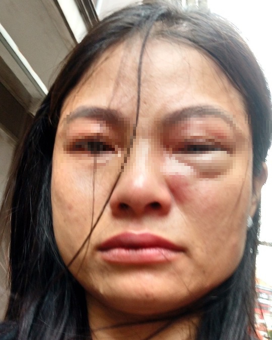 Bà Y. tố bị chồng nhiều lần bạo hành, đánh bầm tím vùng mặt
