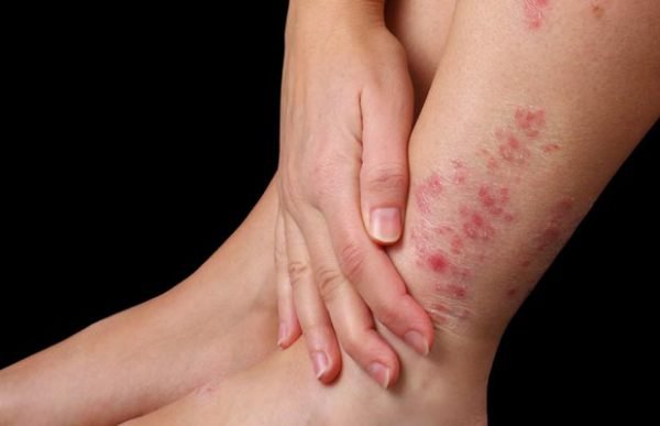 Tình trạng khô sần do viêm da cơ địa.