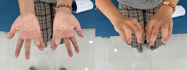 Hai bàn tay của bệnh nhi Thư Kỳ trước và sau phẫu thuật. Ảnh: Chu Dũng