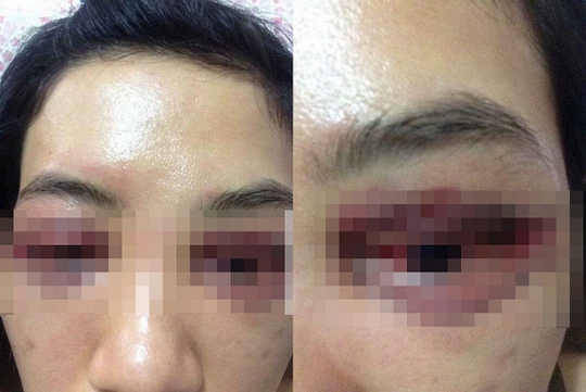 Nữ bệnh nhân mắt bị mưng mủ, biến dạng do cắt mí hỏng tại cơ sở không có chuyên môn
