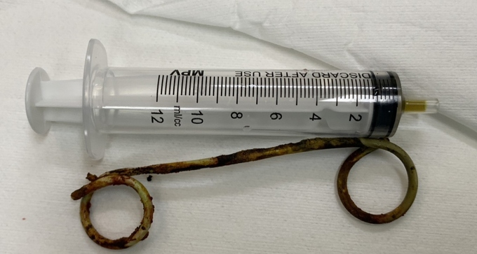 Stent được lấy ra từ ống mật chủ của bệnh nhân sau 6 năm.