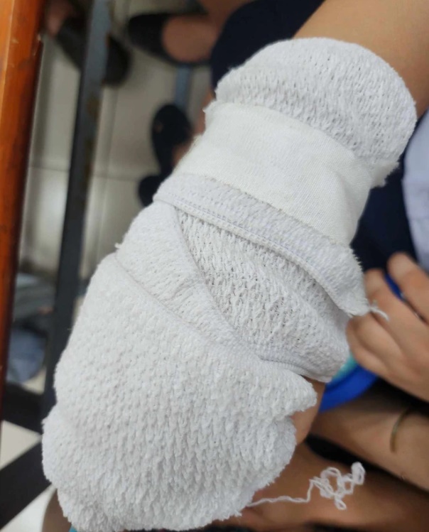 Tay em học sinh phải băng bó sau khi bị đánh