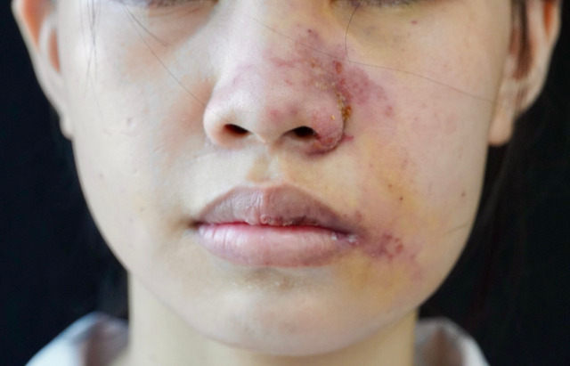 Bệnh nhân N.T.T. bị sưng vù mặt, loét da do biến chứng của việc làm đẹp nhanh với filler (ảnh: BVCC).