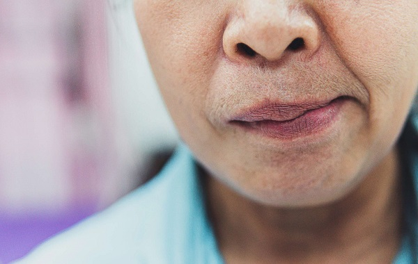 Liệt mặt hay còn gọi là liệt dây thần kinh số VII có thể xảy ra ở mọi đối tượng.