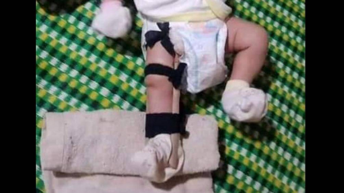Bé 2 tháng tuổi bị đánh gãy chân.