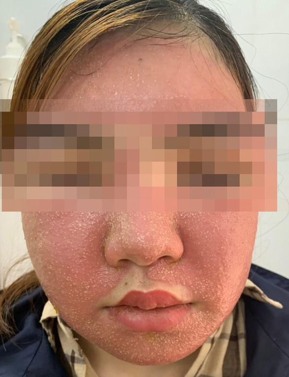 Mặt bệnh nhân bị sưng phù, đầy mụn mủ sau khi đắp mặt nạ mua trên mạng - Ảnh: DO bệnh viện cung cấp