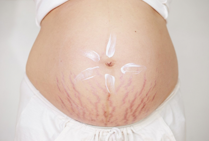 Bổ sung hạt macca trong suốt thai kỳ không chỉ tốt cho sức khỏe mẹ và bé mà còn đẩy lùi tình trạng rạn da.