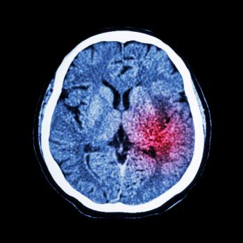 Tiêm tế bào gốc SB623 vào vùng não tổn thương do đột quỵ đã phục hồi chức năng vận động cho bệnh nhân.