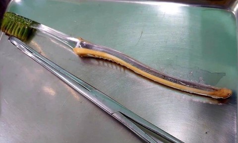 Dị vật là chiếc bàn chải đánh răng được phẫu thuật từ trong dạ dày bệnh nhi. Ảnh: CTV
