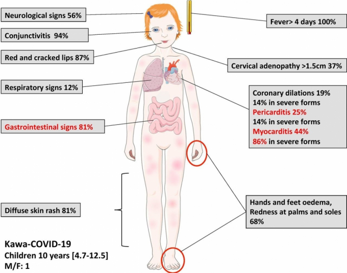 Hội chứng viêm đa hệ ở trẻ em liên quan đến virus SARS-CoV-2 có các triệu chứng như bệnh Kawasaki. Ảnh BMJ Journals
