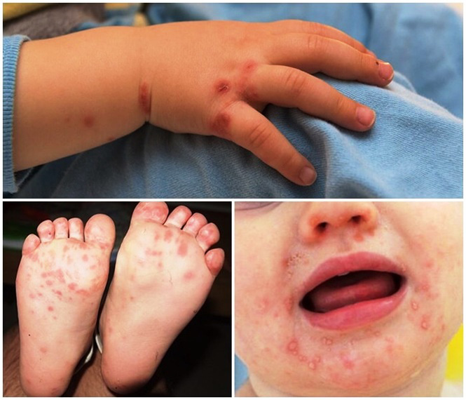 Lâm Đồng bùng phát dịch bệnh tay chân miệng ở trẻ em đang lan rộng.